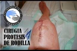 Protesis de rodilla, operacion o cirugia