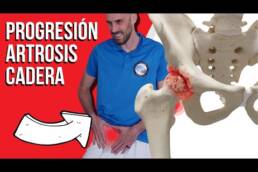Progresión de ejercicios para artrosis de cadera