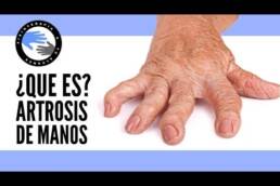 Artrosis de manos y dedos, causas, síntomas y tratamiento