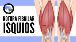 Rotura fibrilar de los isquiotibiales, que es, por que se produce, diagnostico y tratamiento