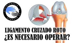 Rotura de ligamentos cruzados, ¿es necesaria la operacion?