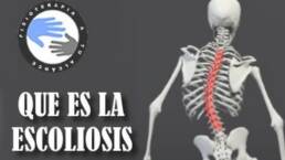 Que es la escoliosis de columna