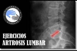 Artrosis de columna lumbar ejercicios