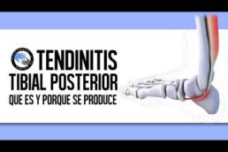 Tendinitis del tibial posterior, que es y por que se produce