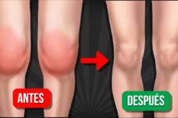5 EJERCICIOS para DESINFLAMAR LA RODILLA y eliminar el LÍQUIDO