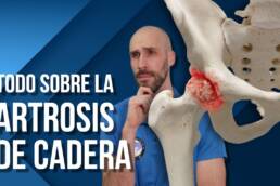 Artrosis de cadera, qué es, por qué se produce, tratamiento y recomendaciones