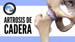 Artrosis de cadera, que es y porque se produce