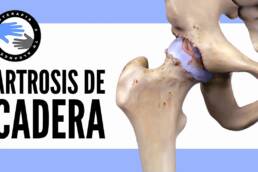 Artrosis de cadera, que es y porque se produce