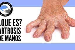 Artrosis de manos y dedos, causas, síntomas y tratamiento