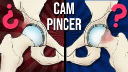 Cadera CAM y PINCER ¿qué son y por que se producen?