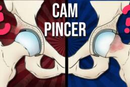 Cadera CAM y PINCER ¿qué son y por que se producen?