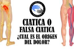 Ciatica o falsa ciatica, como diferenciar el sindrome del piramidal de una hernia