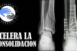 Como acelerar la curacion de una fractura de hueso