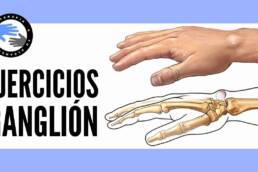 Ejercicios para el  ganglion de muñeca o quiste sinovial