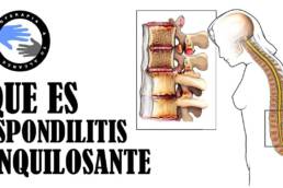 Espondilitis anquilosante, que es y por que se produce