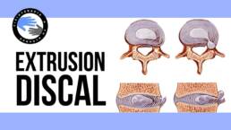 Extrusion discal ¿es realmente tan grave? que es y porque se produce