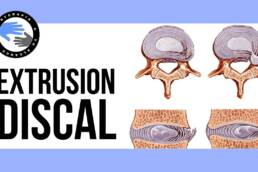 Extrusion discal ¿es realmente tan grave? que es y porque se produce