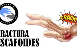Fractura de escafoides mano, por que es importante reconocerla rapidamente