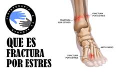 Fractura por estres, que es y cual es su tratamiento