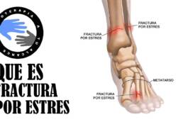 Fractura por estres, que es y cual es su tratamiento