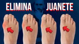 Hallux valgus o juanete, 1 ejercicio y 3 técnicas de masaje para aliviar el dolor