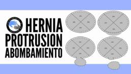 Hernia de disco, protrusion y extrusion discal ¿que son, como diferenciarlas?