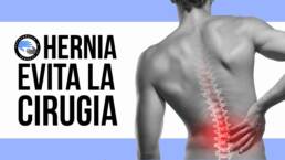 Hernia discal, 3 ejercicios para evitar la cirugia