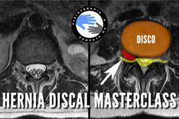 La VERDAD sobre las hernias discales