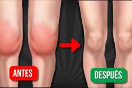 MASAJE para DESINFLAMAR LA RODILLA y eliminar el LÍQUIDO