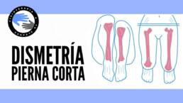 Pierna corta o dismetría de miembros inferiores en el dolor de espalda, rodilla y cadera