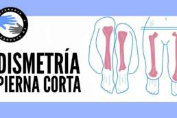 Pierna corta o dismetría de miembros inferiores en el dolor de espalda, rodilla y cadera