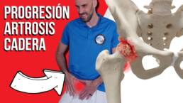 Progresión de ejercicios para artrosis de cadera