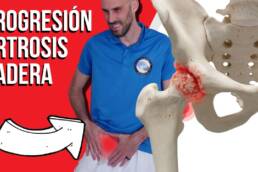 Progresión de ejercicios para artrosis de cadera