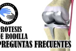 Protesis de rodilla , preguntas frecuentes