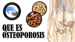 Que es la osteoporosis y porque se produce