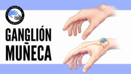 Quiste sinovial o ganglion de muñeca, que es, por que se produce, tratamiento y fisioterapia