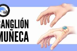Quiste sinovial o ganglion de muñeca, que es, por que se produce, tratamiento y fisioterapia