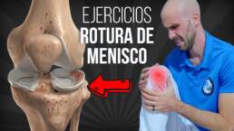 Rutina de EJECICIOS para ROTURA DE MENISCO – FASE 1
