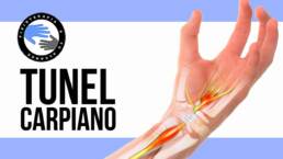 Sindrome del tunel del carpo, que es, porque se produce, sintomas y tratamiento