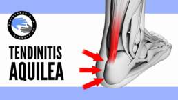 Tendinitis insercional de aquiles, ejercicios y tratamiento para aliviar el dolor