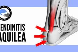 Tendinitis insercional de aquiles, ejercicios y tratamiento para aliviar el dolor