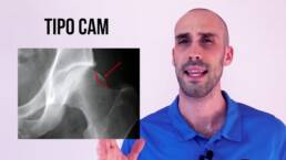 Test de fadir, como detectar el choque femoroacetabular