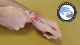 Tendinitis de Quervain o muñeca, que es y como se produce