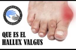 Masaje y ejercicios para juanetes o hallux valgus