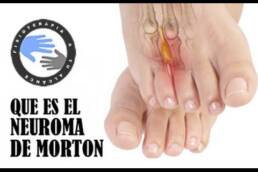 Neuroma de Morton tratamiento y fisioterapia