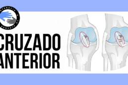 ¿Ligamento cruzado anterior roto? 2 test para evaluarlo
