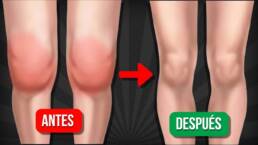 Cómo DESINFLAMAR La Rodilla En Casa SIN Medicamentos (Tumbado)